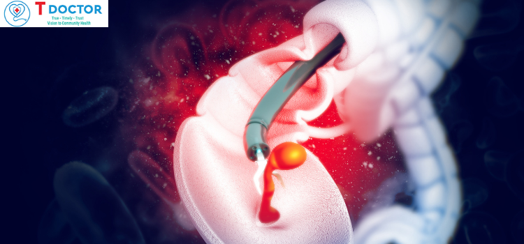 CASE Lâm sàng tiêu hóa - cắt polyp đại tràng| BS. Lê Kiên Hưng